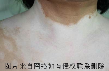 女性白癜风患者怎么保养