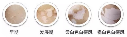 白癜风的早期症状有什么特点
